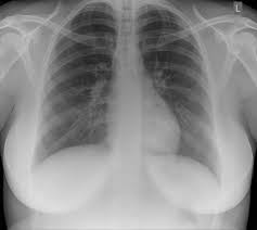 Basic Chest Image Interpretation